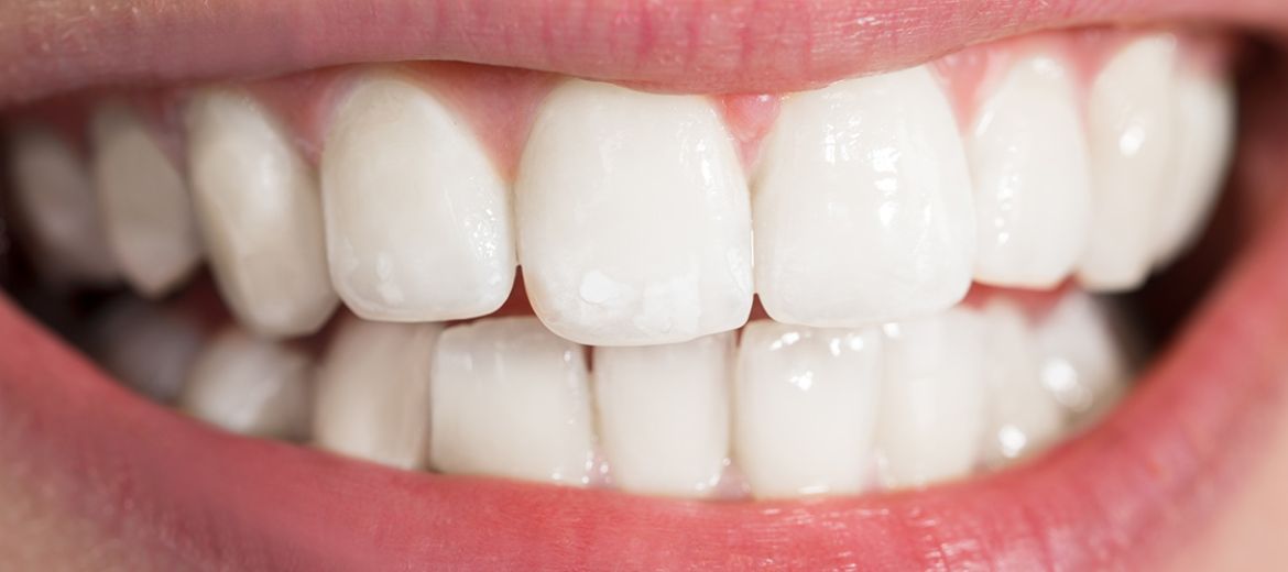 Teeth Whitening