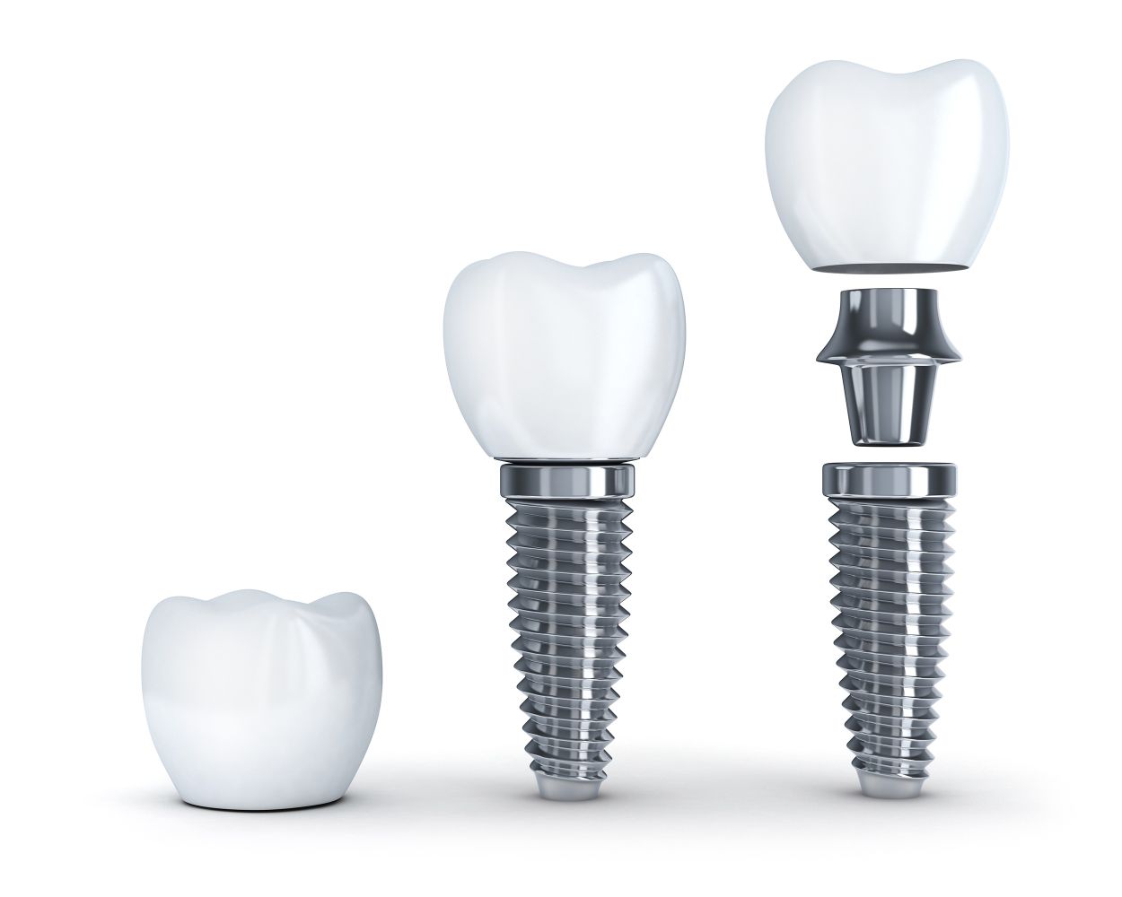 Dental implant at Bourne Dental Practice